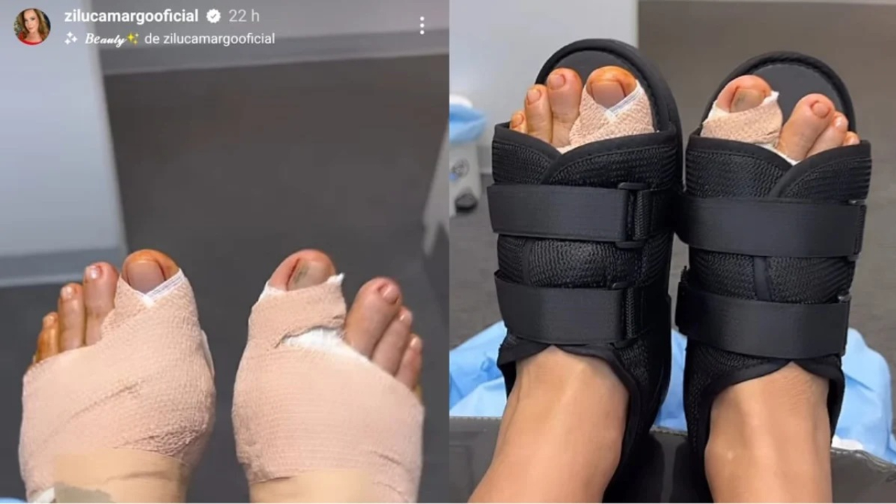 Zilu Camargo passou por cirurgia nos pés (Foto: Reprodução)