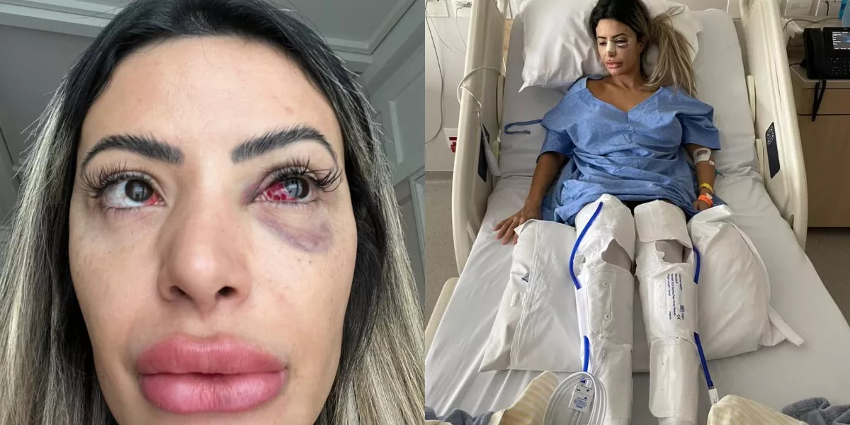 Horror em Paris: Influenciadora brasileira é brutalmente agredida pelo namorado