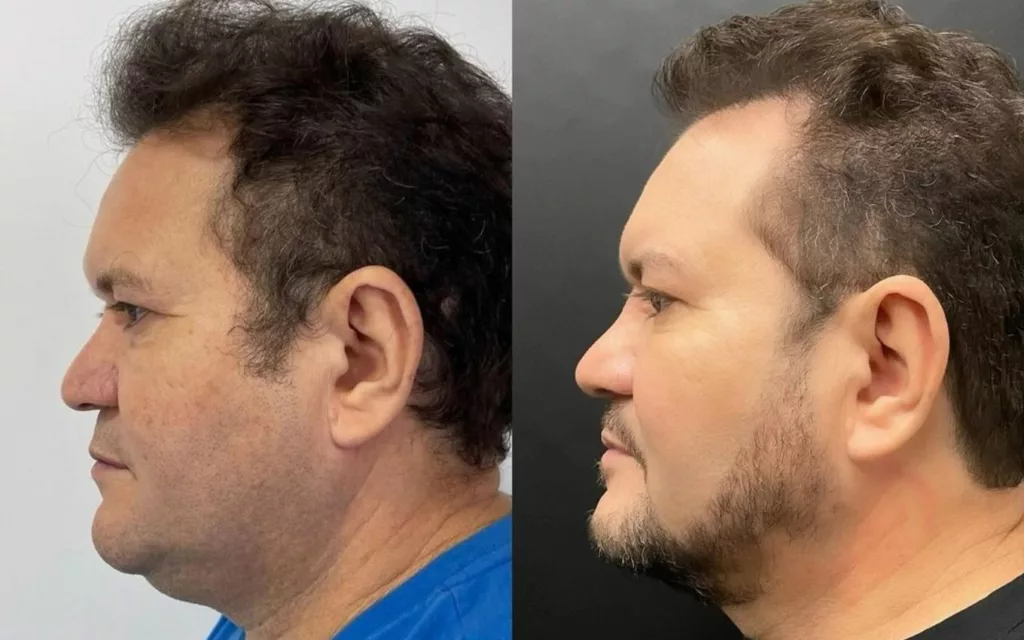 Ximbinha antes e depois da harmonização facial (Foto: Reprodução / Instagram)