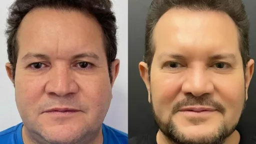 Ximbinha antes e depois da harmonização facial (Foto: Reprodução / Instagram)